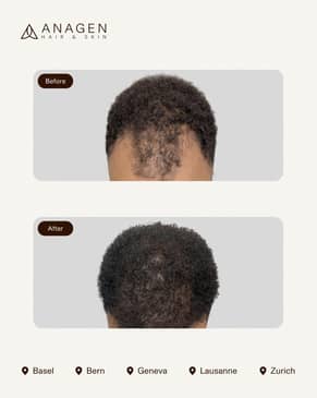 Slider image (7) Anagen - Hair Transplant Clinic in Switzerland